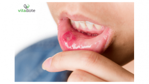 como se livrar das úlceras na boca